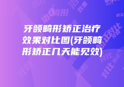 牙颌畸形矫正治疗效果对比图(牙颌畸形矫正几天能见效)